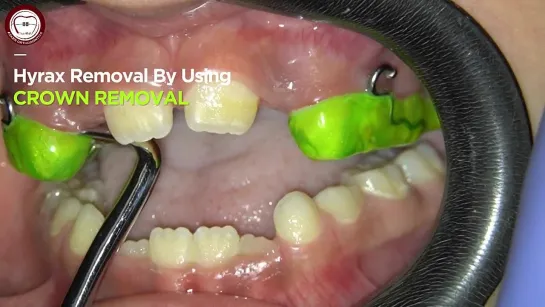 Removal of bonded HYRAX by Dr. Amr Asker