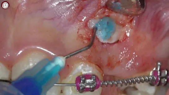 ectopic impacted canine traction using apical reposition and chain traction