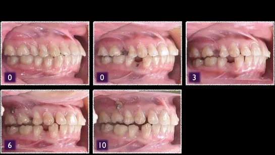 Chris Chang Ortho. Atypical extraction strategy for bimaxillary protrusion treatment