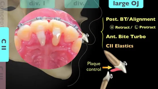 BT  Elastics. Timing  Position - Part 2. Ортодонтия.