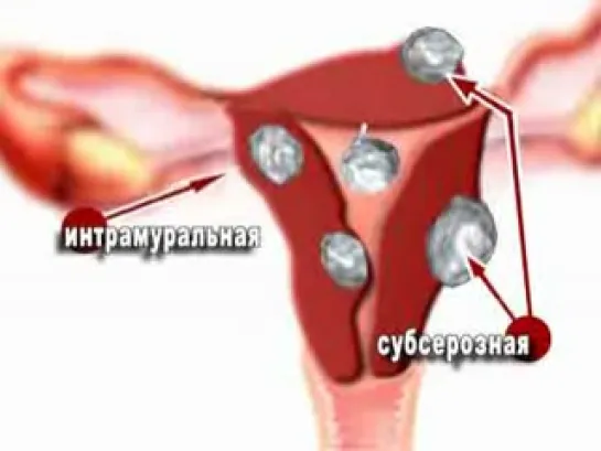 Миома матки